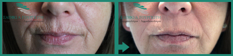 Αποτελέσματα χρήσης υαλουρονικού οξέoς Αποτελέσματα χρήσης υαλουρονικού οξέoς